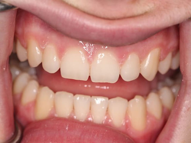 invisalign-teenager-b1