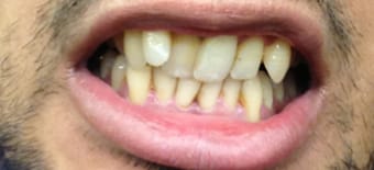Before cosmetic Treatment Reading Smiles