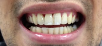 After cosmetic Treatment Reading Smiles