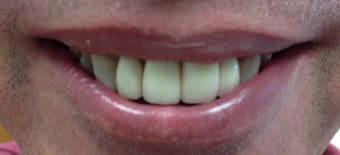 After Veneers Treatment Reading Smiles