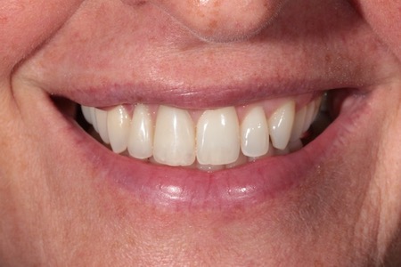 After Veneers Treatment Reading Smiles