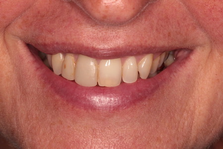 Before veneers Treatment Reading Smiles
