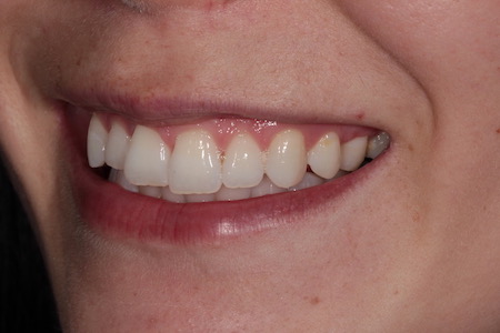 Before Invisalign Treatment Reading Smiles