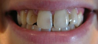 Before veneers Treatment Reading Smiles
