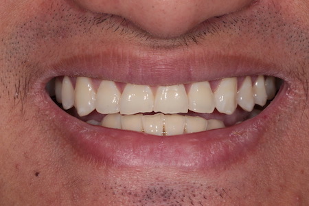 Before Invisalign Treatment Reading Smiles