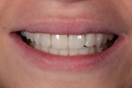 After Veneers Treatment Reading Smiles
