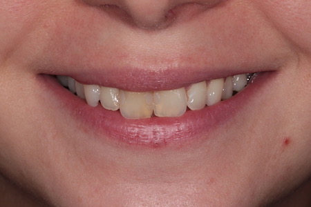 Before veneers Treatment Reading Smiles