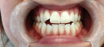 Before cosmetic Treatment Reading Smiles