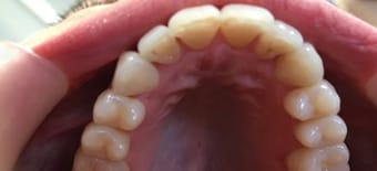 After cosmetic Treatment Reading Smiles