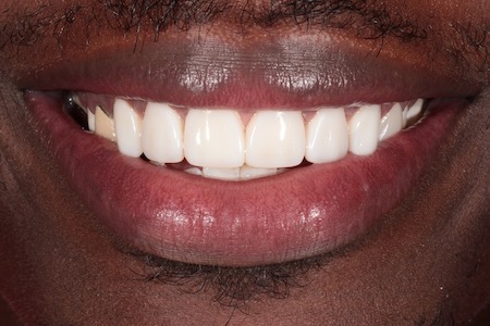 After Veneers Treatment Reading Smiles