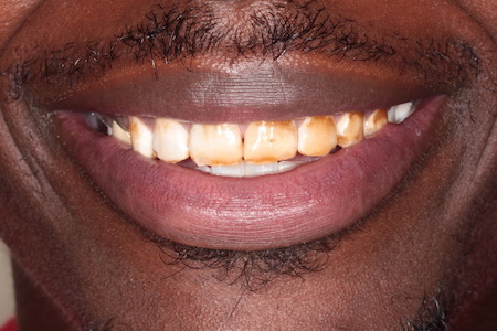 Before veneers Treatment Reading Smiles