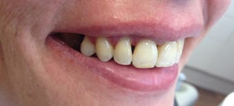 After Veneers Treatment Reading Smiles