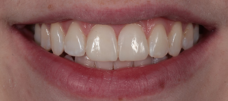 After Invisalign Treatment Reading Smiles