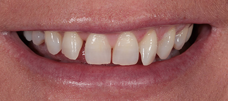 Composite Bonding Cases