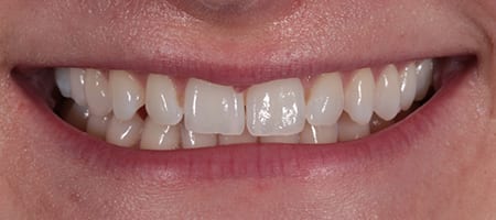 Composite Bonding Cases