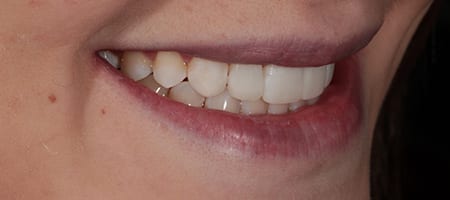 After Invisalign Treatment Reading Smiles