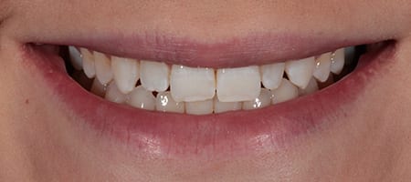 Composite Bonding Cases