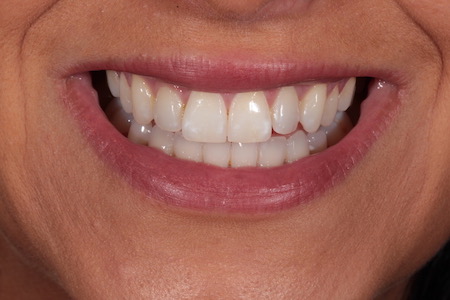 Before Invisalign Treatment Reading Smiles