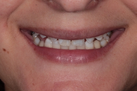 Before Invisalign Treatment Reading Smiles