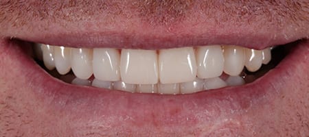 After Invisalign Treatment Reading Smiles