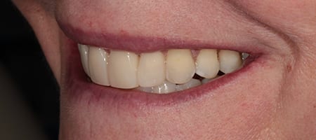 After Invisalign Treatment Reading Smiles