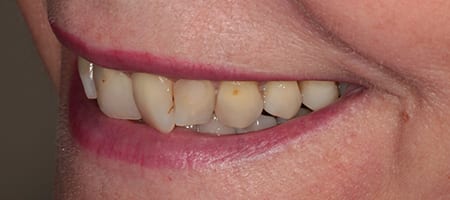 Composite Bonding Cases