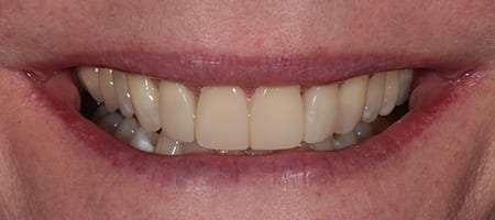 After Invisalign Treatment Reading Smiles