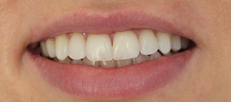 After Invisalign Treatment Reading Smiles After Invisalign Treatment Reading Smiles