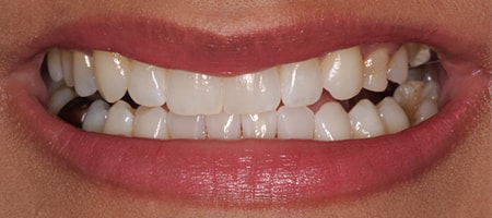 After Invisalign Treatment Reading Smiles After Invisalign Treatment Reading Smiles