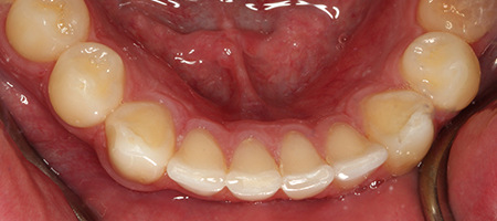 After Invisalign Treatment Reading Smiles After Invisalign Treatment Reading Smiles