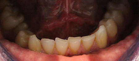 Before Invisalign Treatment Reading Smiles Before Invisalign Treatment Reading Smiles