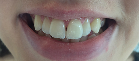 Before Invisalign Treatment Reading Smiles Before Invisalign Treatment Reading Smiles