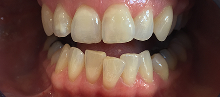 Before Invisalign Treatment Reading Smiles Before Invisalign Treatment Reading Smiles