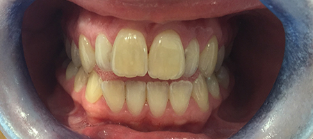 Before Invisalign Treatment Reading Smiles Before Invisalign Treatment Reading Smiles