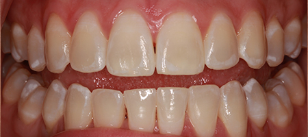 After Invisalign Treatment Reading Smiles After Invisalign Treatment Reading Smiles