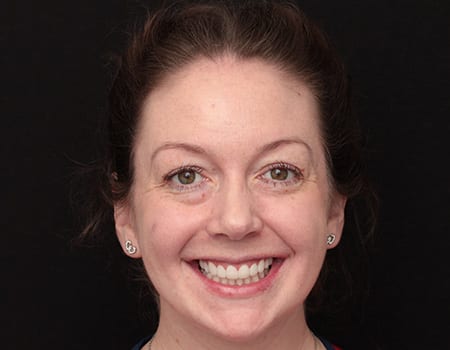 After Invisalign Treatment Reading Smiles