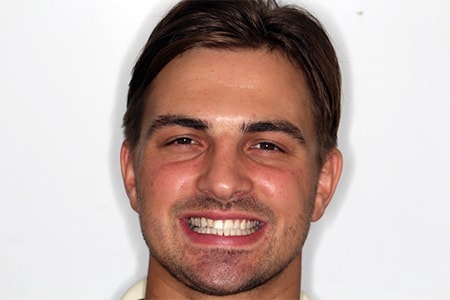 After Invisalign Treatment Reading Smiles After Invisalign Treatment Reading Smiles