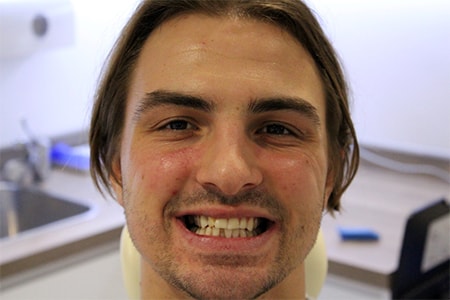 Before Invisalign Treatment Reading Smiles Before Invisalign Treatment Reading Smiles