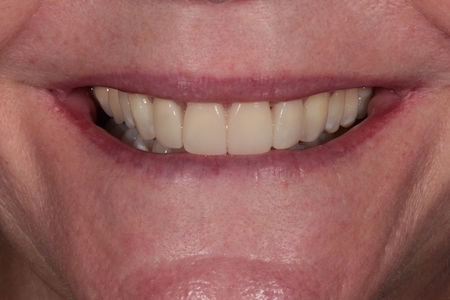 After Smile Makeover Treatment Reading Smiles