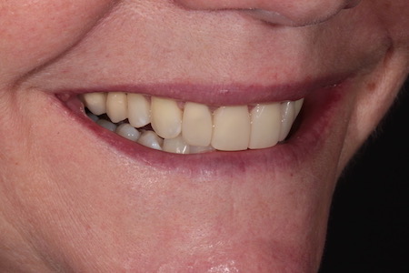 After Smile Makeover Treatment Reading Smiles