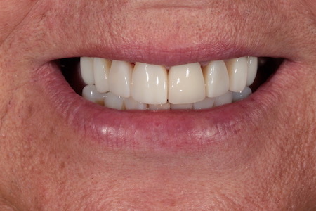 After Veneers Treatment Reading Smiles