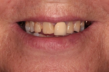 Before veneers Treatment Reading Smiles