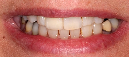 After cosmetic Treatment Reading Smiles