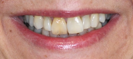 Before cosmetic Treatment Reading Smiles
