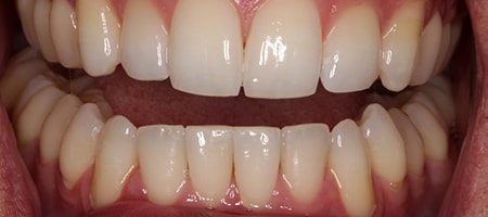 After Invisalign Treatment Reading Smiles After Invisalign Treatment Reading Smiles