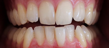 Before Invisalign Treatment Reading Smiles Before Invisalign Treatment Reading Smiles