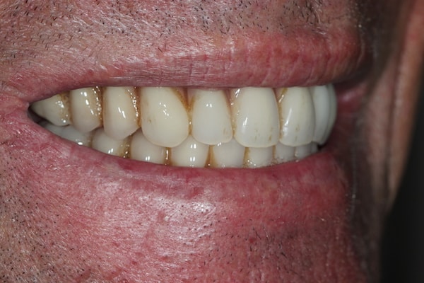 After Invisalign Treatment Reading Smiles