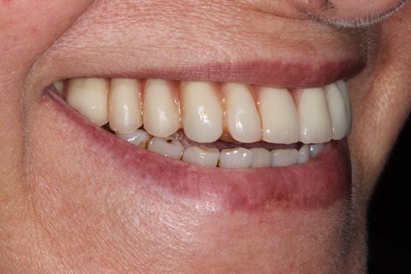After Invisalign Treatment Reading Smiles
