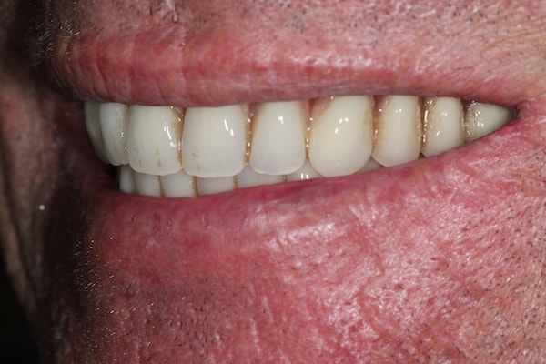 After Invisalign Treatment Reading Smiles