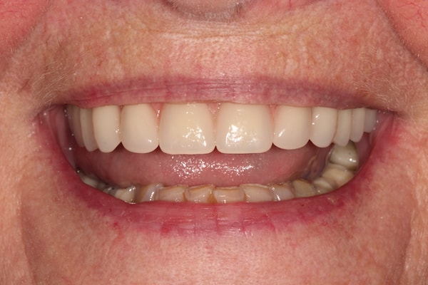 After Invisalign Treatment Reading Smiles